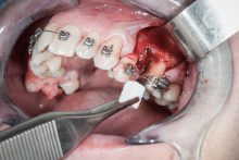 Zebodoly_poekstrakcyjne_ND59693