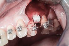 Zebodoly_poekstrakcyjne_ND59699