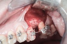 Zebodoly_poekstrakcyjne_ND59704